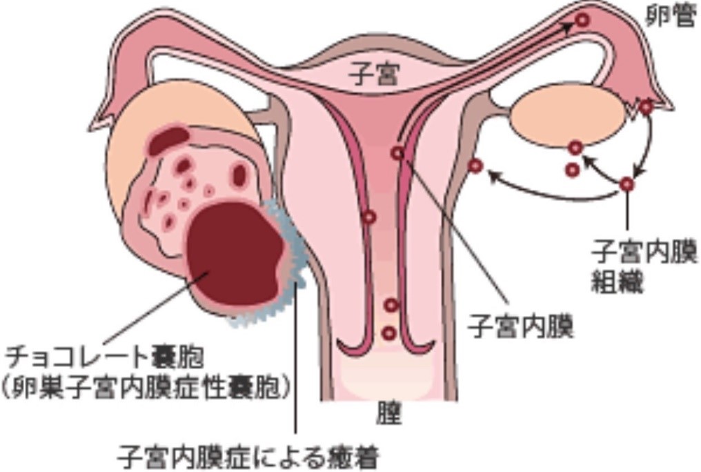 膜 子宮 診断 内 症